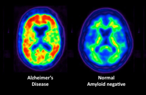 Pet Scan results